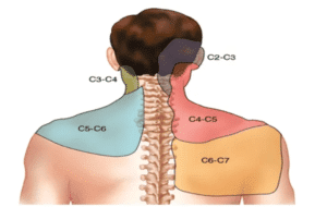 Neck and Shoulder pain